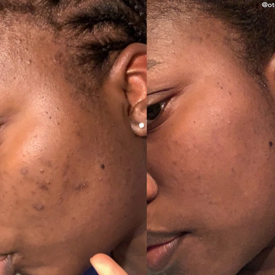 Serum Despigmentante Good Molecules - Discolaration | Depigmenting Serum - Discolaration