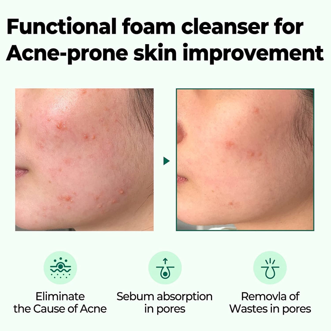 Limpiador Aha.Bha.Pha 30 Days Miracle Acne Clear Some By Mi