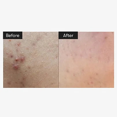 Serum REEDLE SHOT 100 (+REEDLE SHOT 300 1ML*3EA) Vt Cosmetics